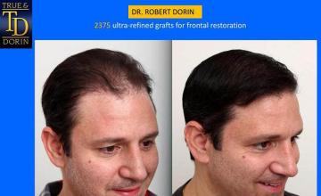 Hair transplantation surgery before and after pictures