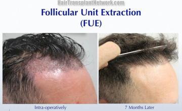 Hair transplantation surgery before and after pictures