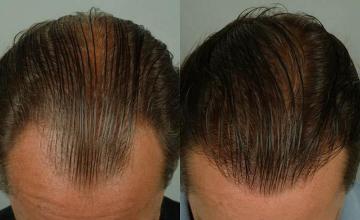 Hair transplantation surgery before and after photos