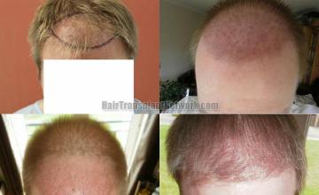 Hair transplantation surgery before and after photos