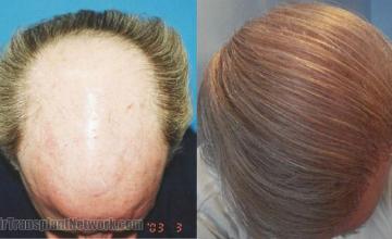 Hair transplantation surgery before and after pictures