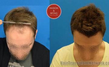 Before and after hair transplant procedure images