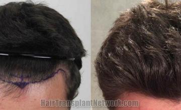 Top view before and after hair restoration results