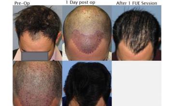 Hair transplantation surgery before and after photos