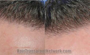 Hair transplant surgery before and after pictures