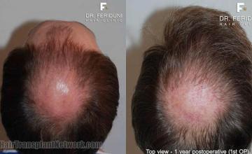 Hair restoration procedure results