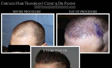 Hair transplantation surgery before and after images