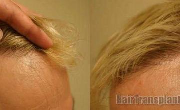 Right and left hairline closeups after hair transplant