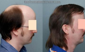 Right view before and after hair replacement images