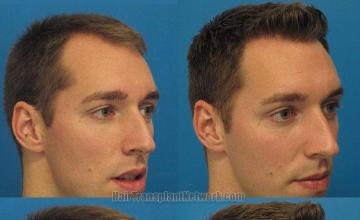 Hair transplantation surgery before and after pictures