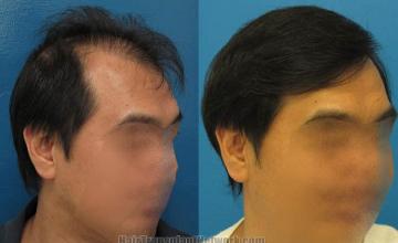 Hair restoration procedure before and after results