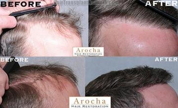 Hair transplantation surgery before and after photos