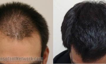 Top view before and after hair restoration results