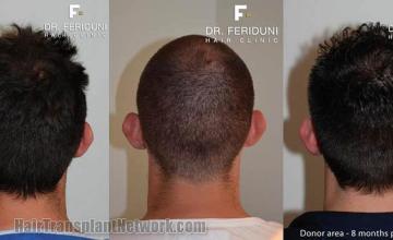 Hair transplantation surgery before and after images