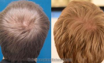 Hair restoration procedure before and after pictures