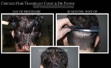 Hair restoration procedure before and after pictures