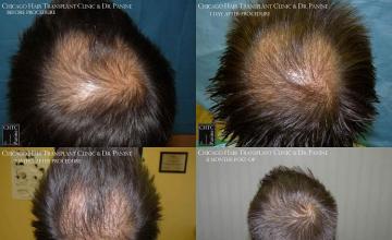 Hair transplantation surgery before and after images