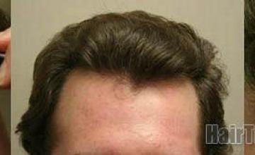 Hairline closeups of  patient