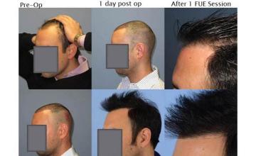 Hair transplantation surgery before and after pictures