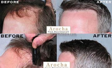 Hair transplantation surgery before and after images