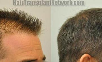 Before and after two hair transplantation procedure