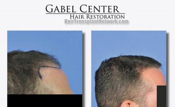 Hair restoration procedure before and after pictures