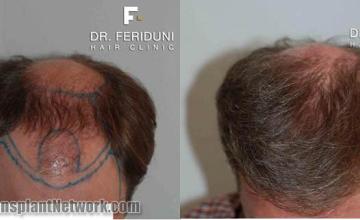 Top view before and after hair restoration procedure