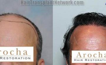 Hair transplantation surgery before and after photos