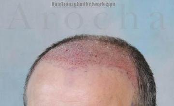 Hair restoration procedure before and after pictures