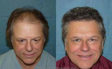 Hair transplant photo results before and after surgery