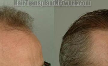 Hair transplantation surgery before and after images