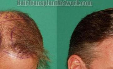 Hair transplantation surgery before and after images