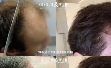 Hair transplantation procedure before and after results