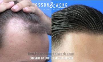 Hair transplantation procedure before and after results