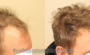 Hair transplantation procedure before and after results