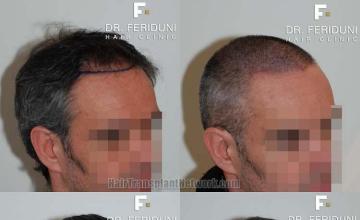 Hair restoration procedure before and after pictures