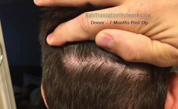 Hair restoration procedure before and after results