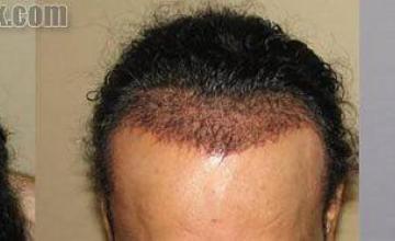 Before and after hair transplant procedure - Tilt down view