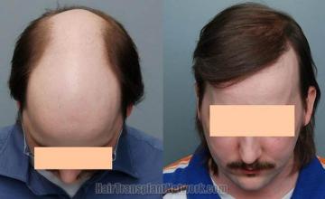 Hair restoration procedure before and after photos