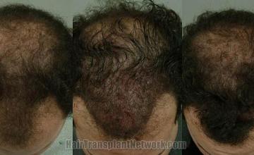 Surgical hair transplantation images before and after