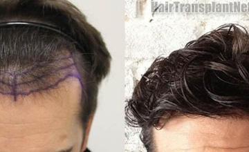 Hair restoration procedure before and after pictures