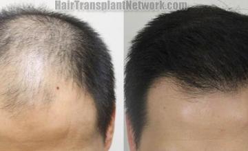 Hair transplantation surgery before and after photos