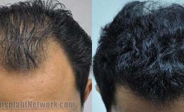 Hair restoration procedure before and after results