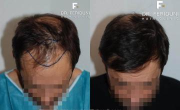 Top view - Before and after surgical hair replacement