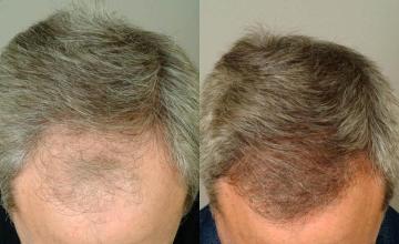 Hair transplantation surgery before and after images