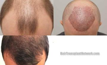 Before and after hair restoration procedure images