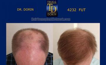 Top view - Before and after hair restoration procedure