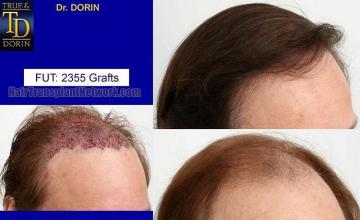 Right view images - Before and after hair transplant