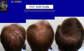 Back / Crown photos before and after hair restoration