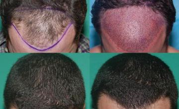 Top view before and after hair restoration results